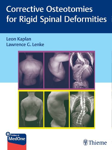 Cover image for Corrective Osteotomies for Rigid Spinal Deformities