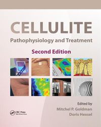 Cover image for Cellulite: Pathophysiology and Treatment