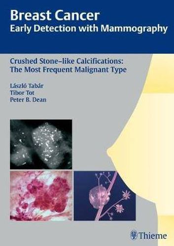 Cover image for Breast Cancer: Early Detection with Mammography: Crushed Stone-like Calcifications: The Most Frequent Malignant Type