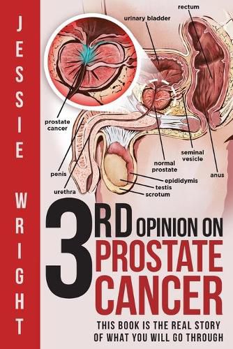 Cover image for 3rd Opinion on Prostate Cancer