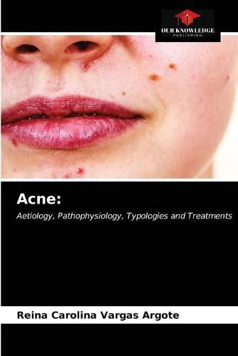 Cover image for Acne