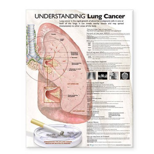 Cover image for Understanding Lung Cancer Anatomical Chart