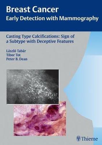 Cover image for Casting-Type Calcifications: Sign of a Subtype with Deceptive Features