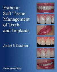 Cover image for Esthetic Soft Tissue Management of Teeth and Implants