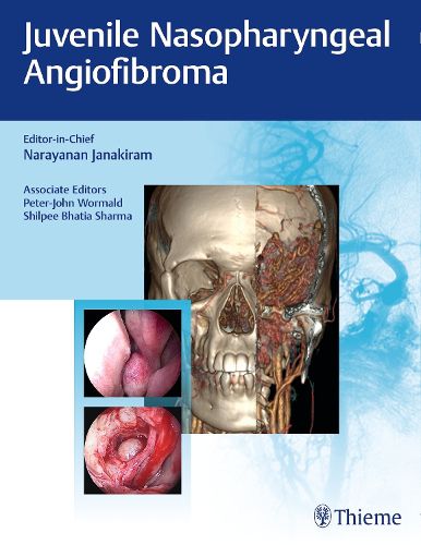 Cover image for Juvenile Nasopharyngeal Angiofibroma