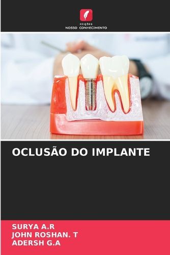Cover image for Oclusao Do Implante