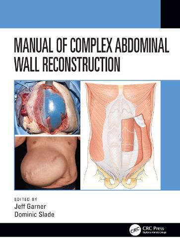 Cover image for Manual of Complex Abdominal Wall Reconstruction