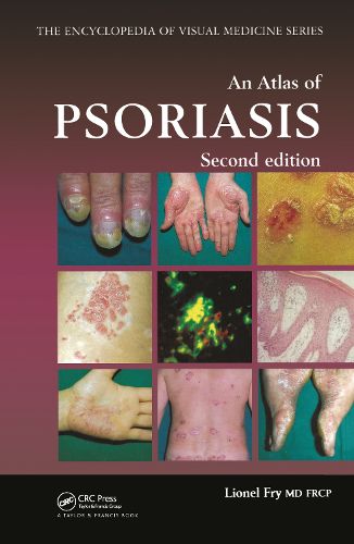 Cover image for An Atlas of Psoriasis, Second Edition