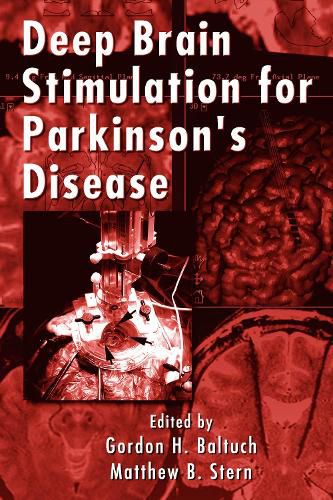 Cover image for Deep Brain Stimulation for Parkinson's Disease