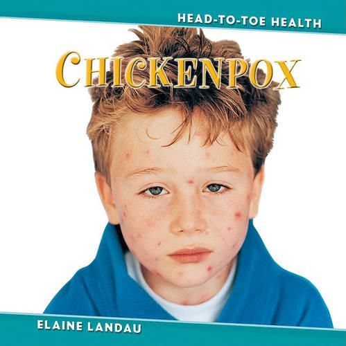 Cover image for Chickenpox