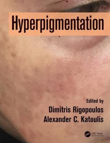 Cover image for Hyperpigmentation