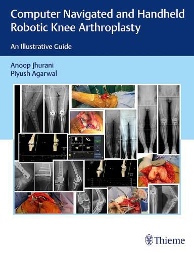 Cover image for Computer Navigated and Handheld Robotic Knee Arthroplasty