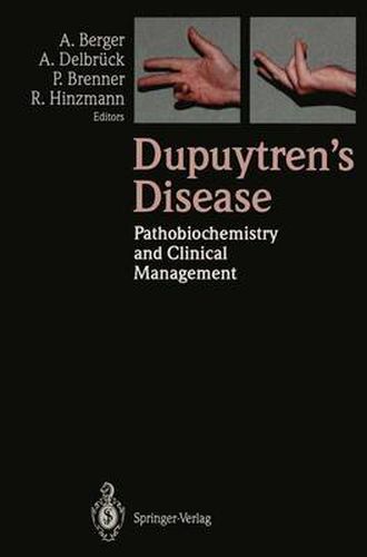 Cover image for Dupuytren's Disease: Pathobiochemistry and Clinical Management