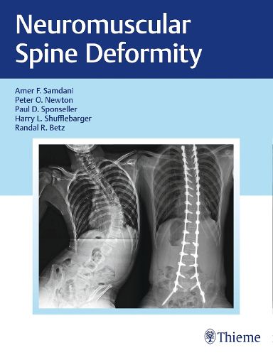 Cover image for Neuromuscular Spine Deformity