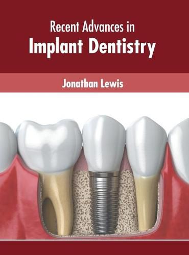 Cover image for Recent Advances in Implant Dentistry