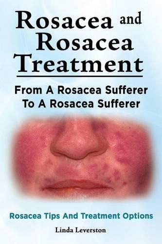 Cover image for Rosacea and Rosacea Treatment. From A Rosacea Sufferer To A Rosacea Sufferer. Rosacea Tips And Treatment Options