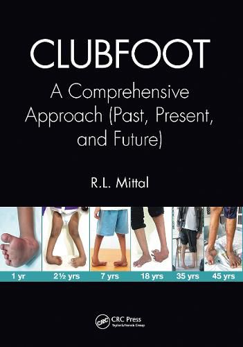 Cover image for Clubfoot: A Comprehensive Approach (Past, Present, and Future)