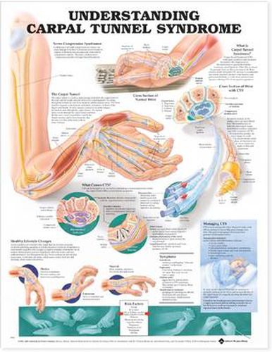 Cover image for Understanding Carpal Tunnel Syndrome Anatomical Chart