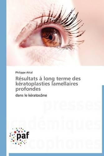 Cover image for Resultats A Long Terme Des Keratoplasties Lamellaires Profondes