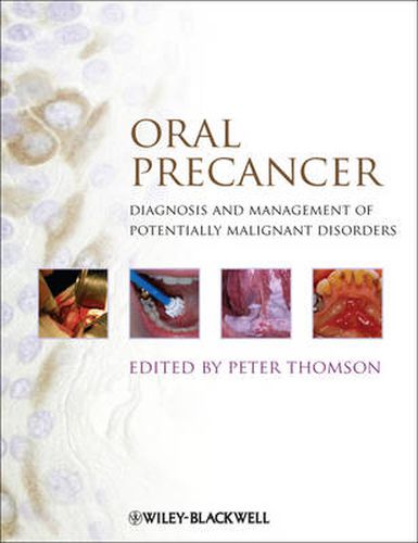 Cover image for Oral Precancer: Diagnosis and Management of Potentially Malignant Disorders