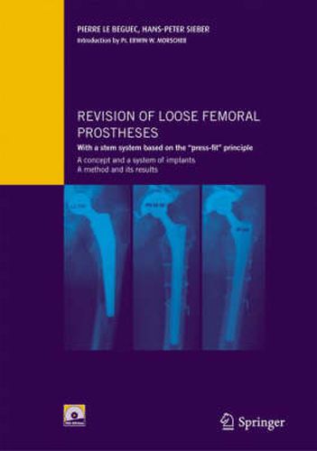 Cover image for Revision of loose femoral prostheses with a stem system based on the  press-fit  principle: A concept and its system of implants, a method and its results