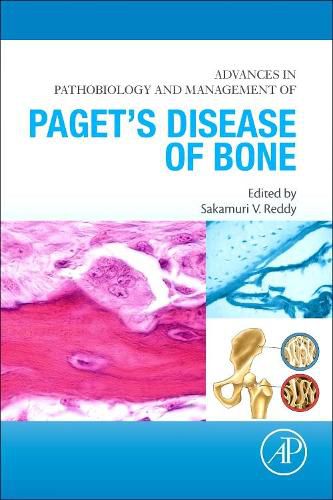 Cover image for Advances in Pathobiology and Management of Paget's Disease of Bone