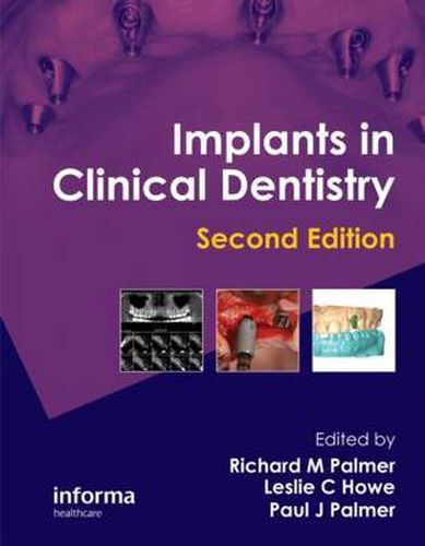 Cover image for Implants in Clinical Dentistry