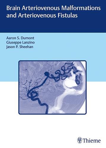 Cover image for Brain Arteriovenous Malformations and Arteriovenous Fistulas