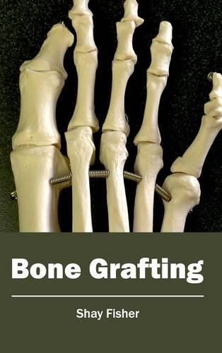 Cover image for Bone Grafting