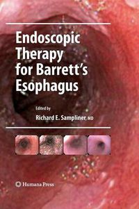 Cover image for Endoscopic Therapy for Barrett's Esophagus