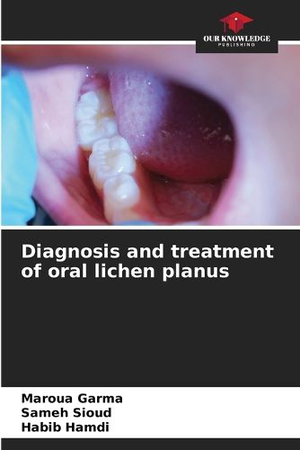 Cover image for Diagnosis and treatment of oral lichen planus