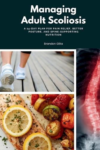 Cover image for Managing Adult Scoliosis