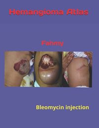 Cover image for Hemangioma Atles