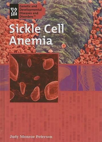 Sickle Cell Anemia