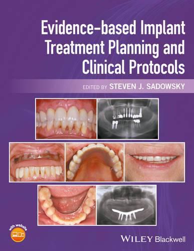 Cover image for Evidence-based Implant Treatment Planning and Clinical Protocols