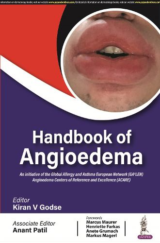 Cover image for Handbook of Angioedema