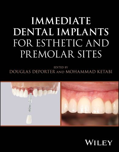 Cover image for Immediate Dental Implants for Esthetic and Premolar Sites