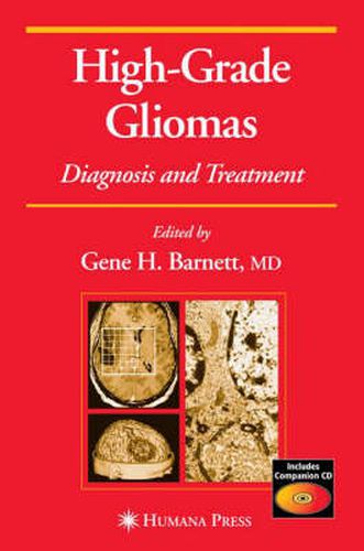 Cover image for High-Grade Gliomas: Diagnosis and Treatment