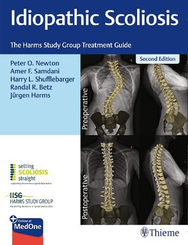 Cover image for Idiopathic Scoliosis: The Harms Study Group Treatment Guide