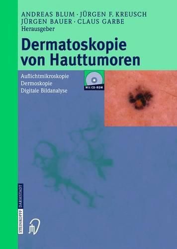 Cover image for Dermatoskopie Von Hauttumoren: Auflichtmikroskopie - Dermoskopie - Digitale Bildanalyse