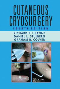 Cover image for Cutaneous Cryosurgery