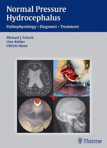 Cover image for NPH - Normal Pressure Hydrocephalus: Pathophysiology - Diagnosis - Treatment