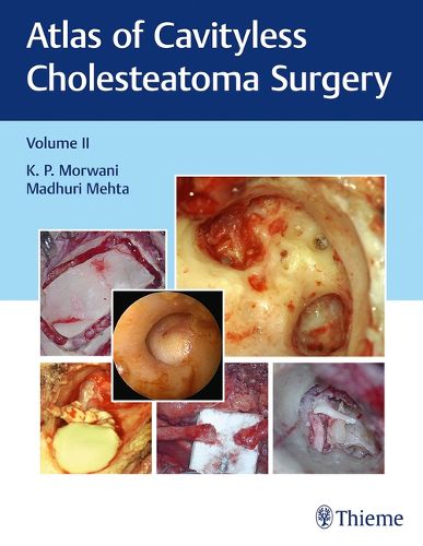 Cover image for Atlas of Cavityless Cholesteatoma Surgery, Vol 2