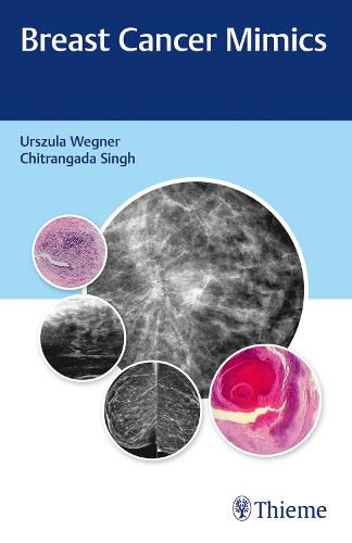 Cover image for Breast Cancer Mimics