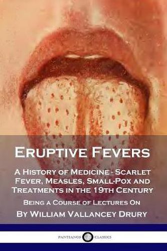 Cover image for Eruptive Fevers: A History of Medicine - Scarlet Fever, Measles, Small-Pox and Treatments in the 19th Century - Being a Course of Lectures On