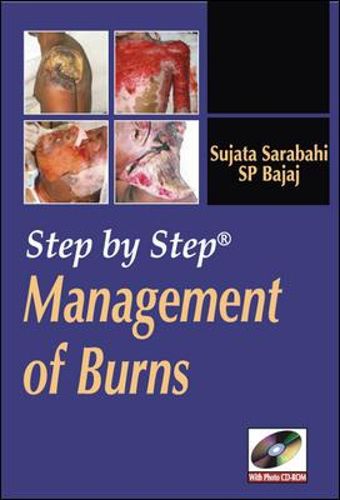 Cover image for Step by Step Management of Burns