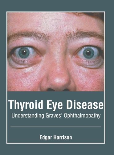 Cover image for Thyroid Eye Disease: Understanding Graves' Ophthalmopathy