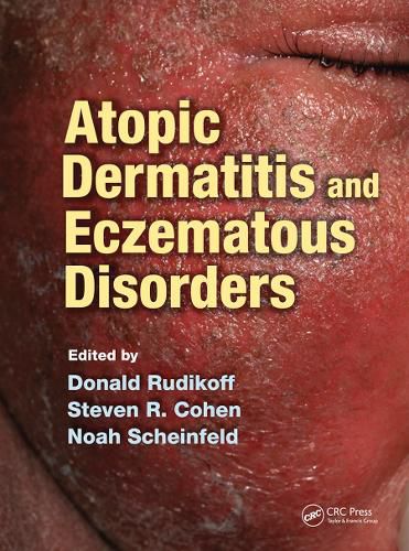 Cover image for Atopic Dermatitis and Eczematous Disorders