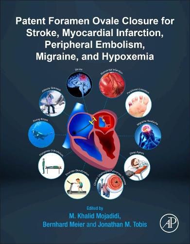 Cover image for Patent Foramen Ovale Closure for Stroke, Myocardial Infarction, Peripheral Embolism, Migraine, and Hypoxemia