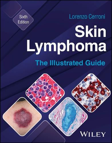 Cover image for Skin Lymphoma